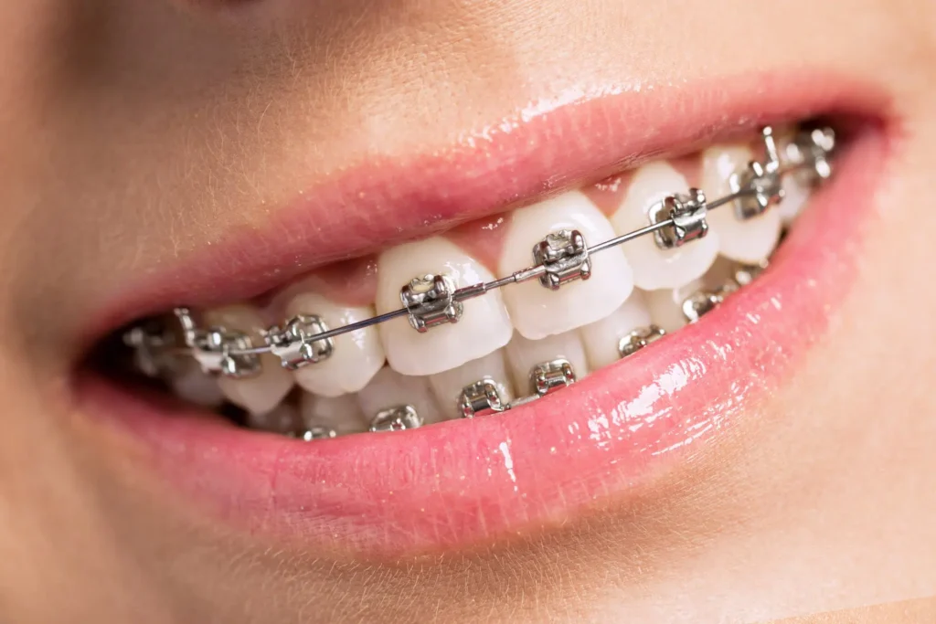 san antonio metal braces