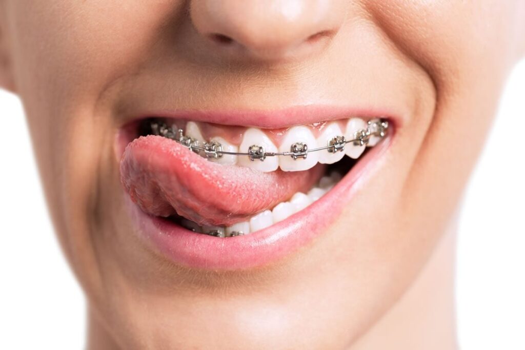 san antonio braces